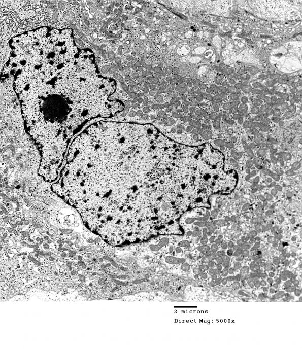 4E8 Spindle Cell Oncocytoma (Case 4) EM 034 - Copy - Copy