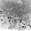 4E9 Spindle Cell Oncocytoma (Case 4) EM 035 - Copy