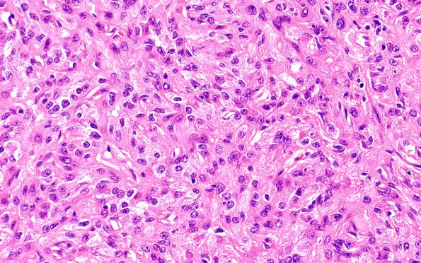 5A4 Spindle cell oncocytoma-pituicytoma DDX (Case 5) H&E 6