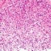 5A5 Spindle cell oncocytoma-pituicytoma DDX (Case 5) H&E 2