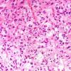 5A6 Spindle cell oncocytoma-pituicytoma DDX (Case 5) H&E 1