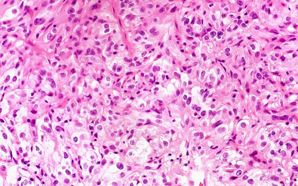 5A6 Spindle cell oncocytoma-pituicytoma DDX (Case 5) H&E 1