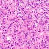 5A7 Spindle cell oncocytoma-pituicytoma DDX (Case 5) H&E 5