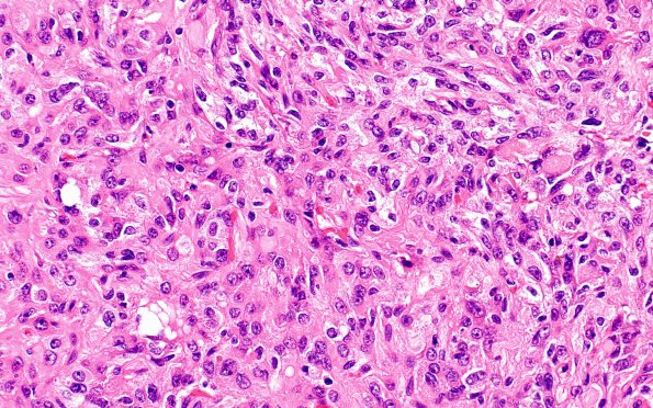 5A7 Spindle cell oncocytoma-pituicytoma DDX (Case 5) H&E 5