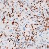 5B3 Spindle cell oncocytoma-pituicytoma DDX (Case 5) TTF1 2