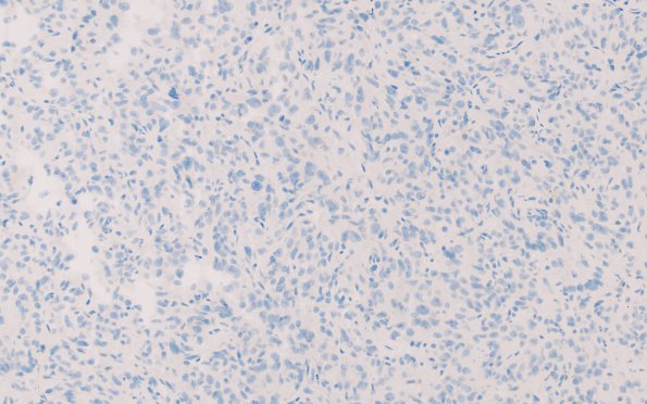 5C Spindle cell oncocytoma-pituicytoma DDX (Case 5) GFAP 1