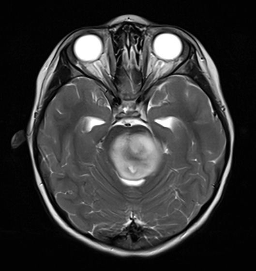 16A4 DMG (Case 16) T2 NOC - Copy | Diffuse midline glioma, H3 K27 ...