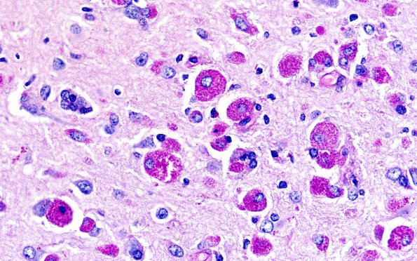 8F3 Granular Cell GBM (Case 8) PAS 60X | Glioblastoma, granular cell ...
