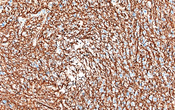 3D1 HGAP (Case 3) NF 20X 2A | High-Grade Astrocytoma with Piloid ...