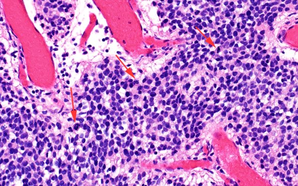 1A4C HPAP (Case 1) H&E 40X copy | High-Grade Glioma with Pleomorphic ...