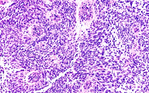 1B3 HPAP (Case 1) H&E 20X 1 | High-Grade Glioma with Pleomorphic and ...