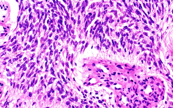1B5 HPAP (Case 1) H&E 40X 5 | High-Grade Glioma with Pleomorphic and ...