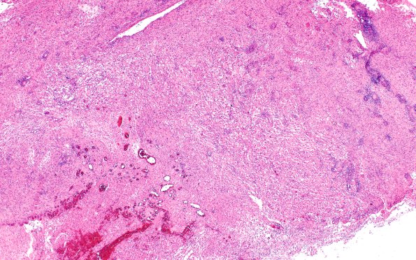 22B2 PXA (Case 22) H&E 4X | Pleomorphic Xanthoastrocytoma (PXA ...