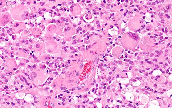22B7 PXA (Case 22) A2 H&E 40X | Pleomorphic Xanthoastrocytoma (PXA ...