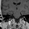 1A1 Int audit canal lipoma (Case 1) T1W