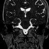 1A3 Int audit canal lipoma (Case 1) T2 1