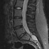 10A2 MPNST (Case 10) T2 3 - Copy