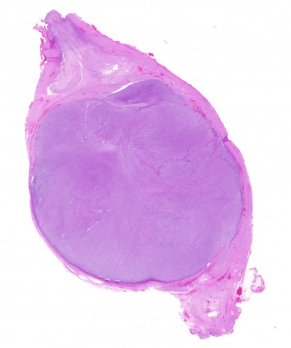 10C1 MPNST (Case 10) H&E whole mount