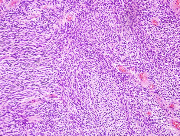 10C2 MPNST (Case 10) H&E 6