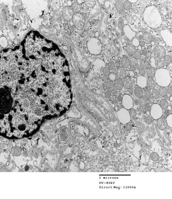 11D1 MPNST (Case 11) EM 007 - Copy