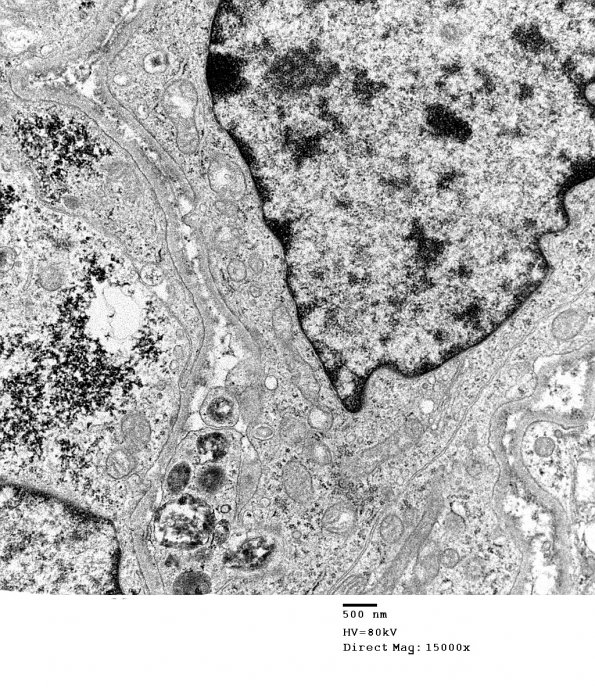 11D3 MPNST (Case 11) EM 013 - Copy