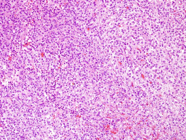 11E1 MPNST (Case 11) recurrence H&E 4