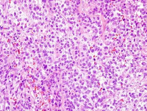 11E2 MPNST (Case 11) recurrence H&E 1