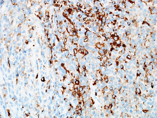 11F MPNST (Case 11) recurrence (leu-7) 1