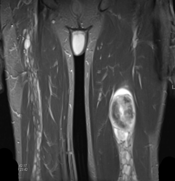 12A1 MPNST, triton tumor (Case 12) STIR 2 - Copy