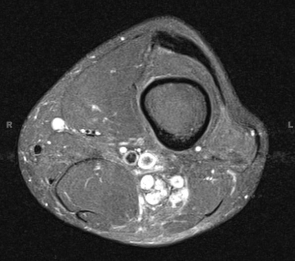 12A3 MPNST, triton tumor (Case 12) T2 2 - Copy