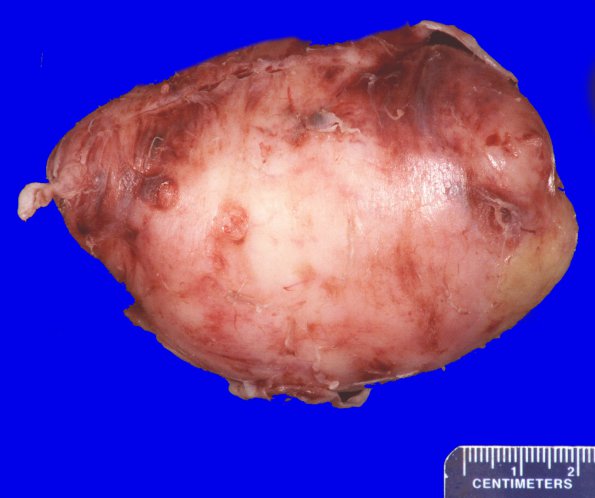 12B1 MPNST, triton tumor (Case 12) Gross _1