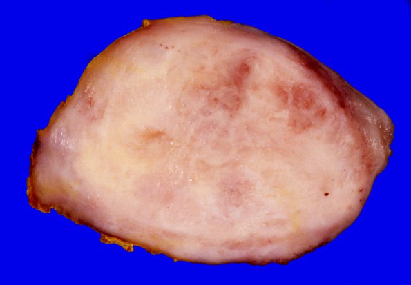 12B2 MPNST, triton tumor (Case 12) Gross _3