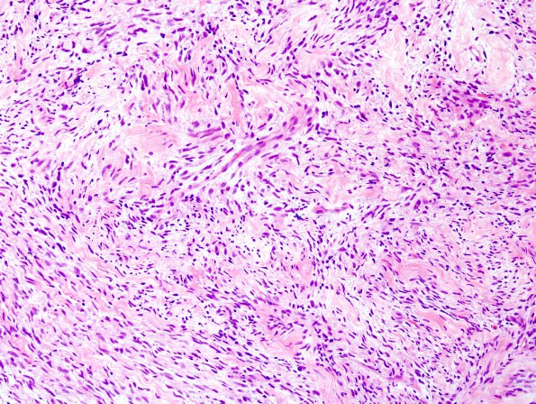 12C3 MPNST, triton tumor (Case 12) A3 H&E 1.jpg