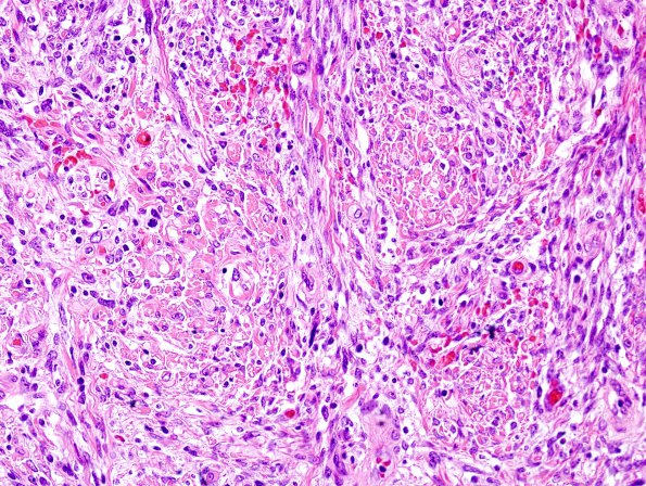 12C4 MPNST, triton tumor (Case 12) H&E 1.jpg