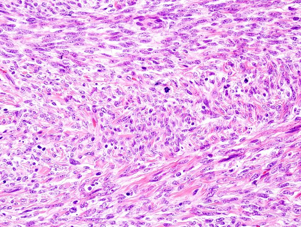 12C5 MPNST, triton tumor (Case 12) H&E 2.jpg