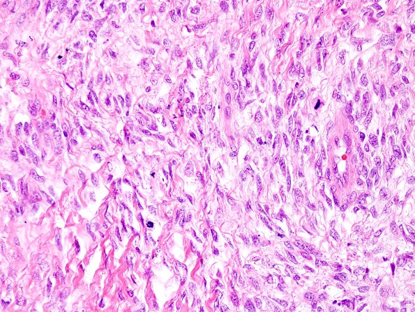 12C7 MPNST, triton tumor (Case 12) H&E 14.jpg