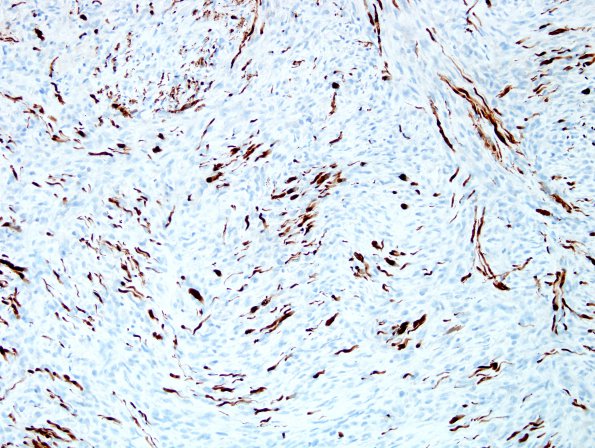 12D1 MPNST, triton tumor (Case 12) A3 S100.jpg