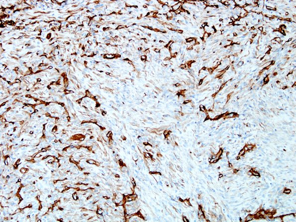 12D2 MPNST, triton tumor (Case 12) A3 Coll IV 2.jpg