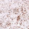 12E2 MPNST, triton tumor (Case 12) Desmin 1.jpg