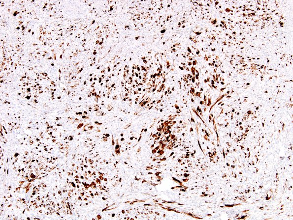 12E2 MPNST, triton tumor (Case 12) Desmin 1.jpg