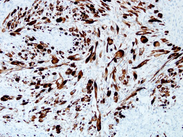 12E3 MPNST, triton tumor (Case 12) Desmin 6.jpg