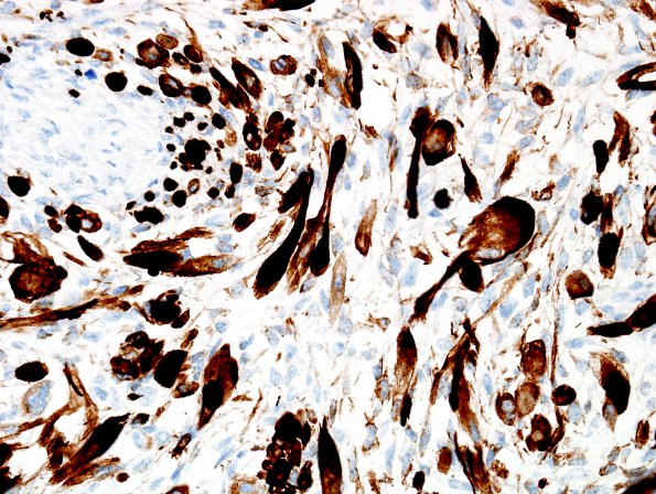 12E4 MPNST, triton tumor (Case 12) Desmin 7.jpg