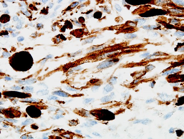 12E5 MPNST, triton tumor (Case 12) Desmin 100X 1.jpg