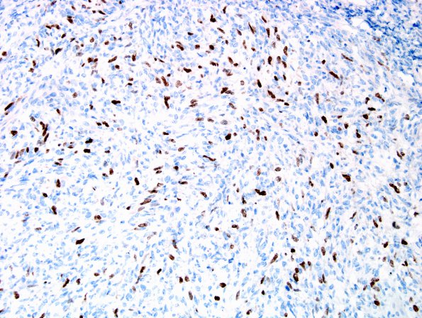 12F2 MPNST, triton tumor (Case 12) Myogenin 3.jpg