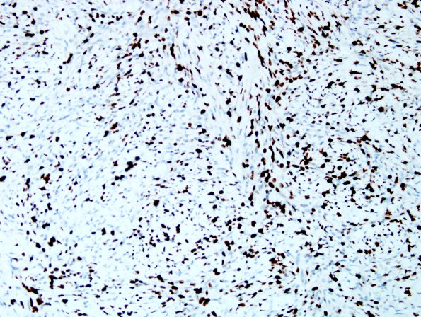 12G MPNST, triton tumor (Case 12) A3 Ki67 1.jpg