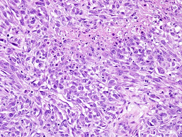 14B4 MPNST African Wild Dog (Case 14) intraventricular H&E 5