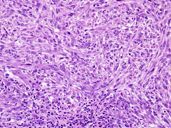 14B5 MPNST African Wild Dog (Case 14) intraventricular H&E 16