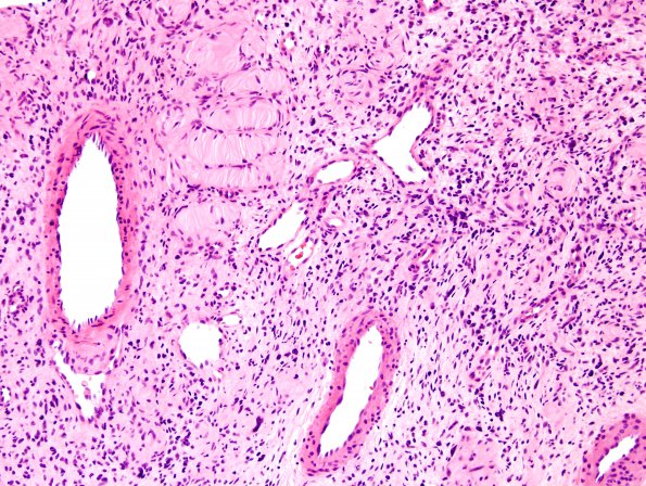 16A2 MPNST with Meissner's (Case 16) H&E 3