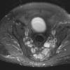 18A1 MPNST, plex NF in NF1, epitheloid (Case 18) - Copy