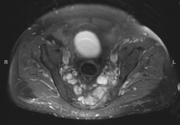 18A1 MPNST, plex NF in NF1, epitheloid (Case 18) - Copy